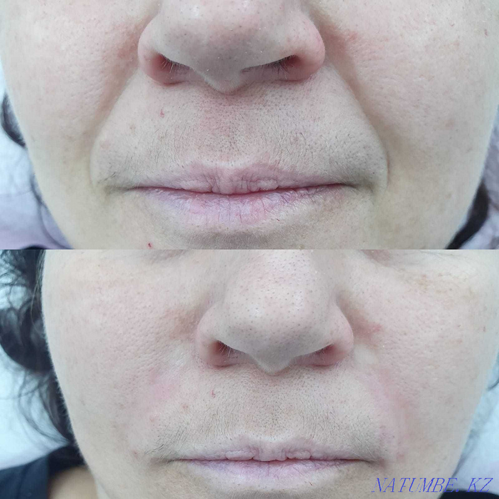 Косметолог в Актау .Увеличение губ. Актау - изображение 8