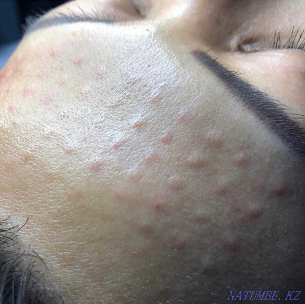 Косметолог в Актау .Увеличение губ. Актау - изображение 6