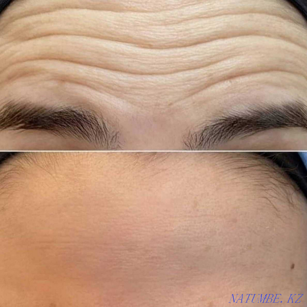 Косметолог в Актау .Увеличение губ. Актау - изображение 3