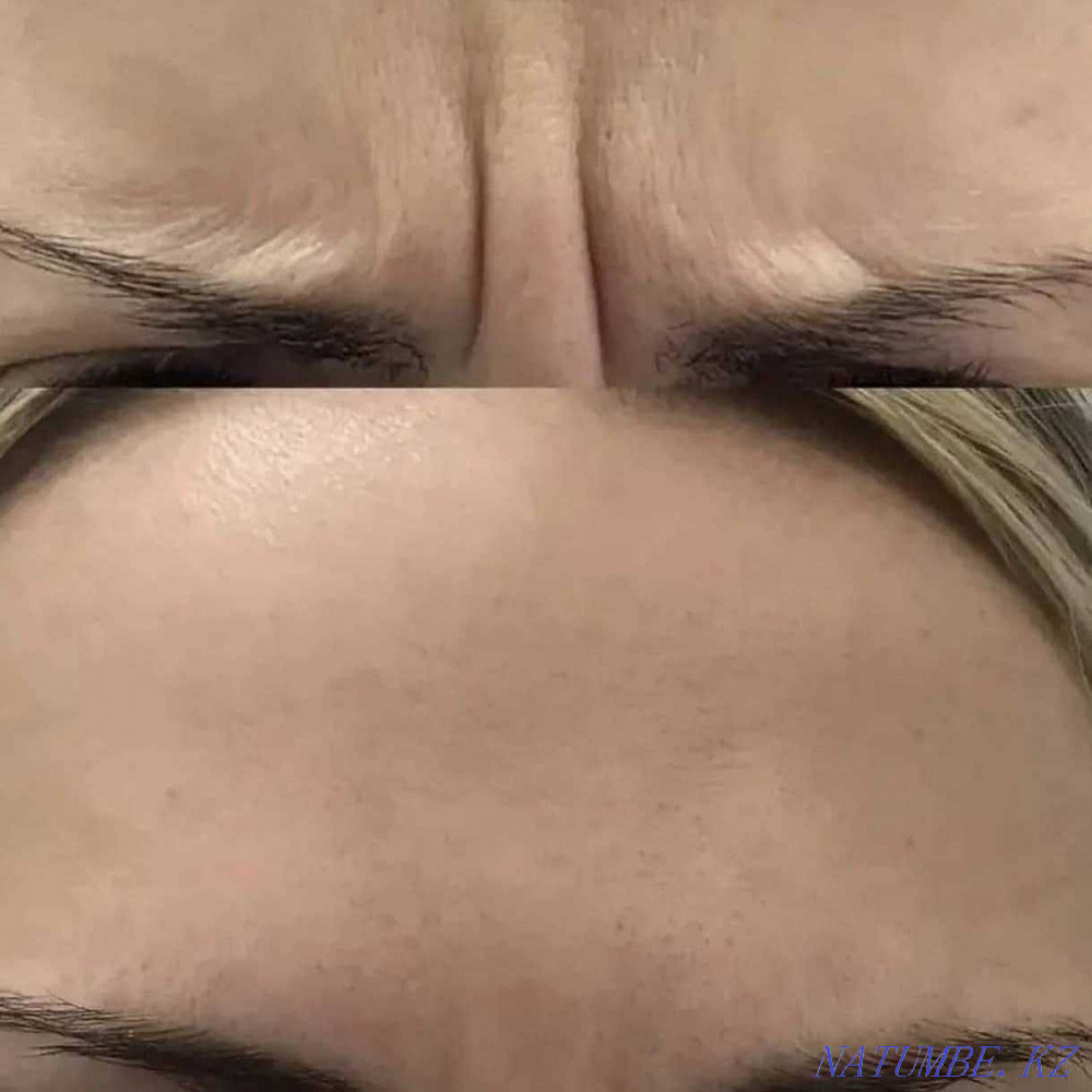 Косметолог в Актау .Увеличение губ. Актау - изображение 5