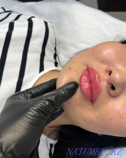 LIP Augmentation 25,000 thousand!!! Temirtau - photo 1