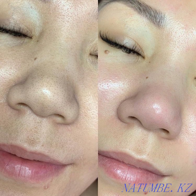 Cosmetology. Facial care Astana - photo 4