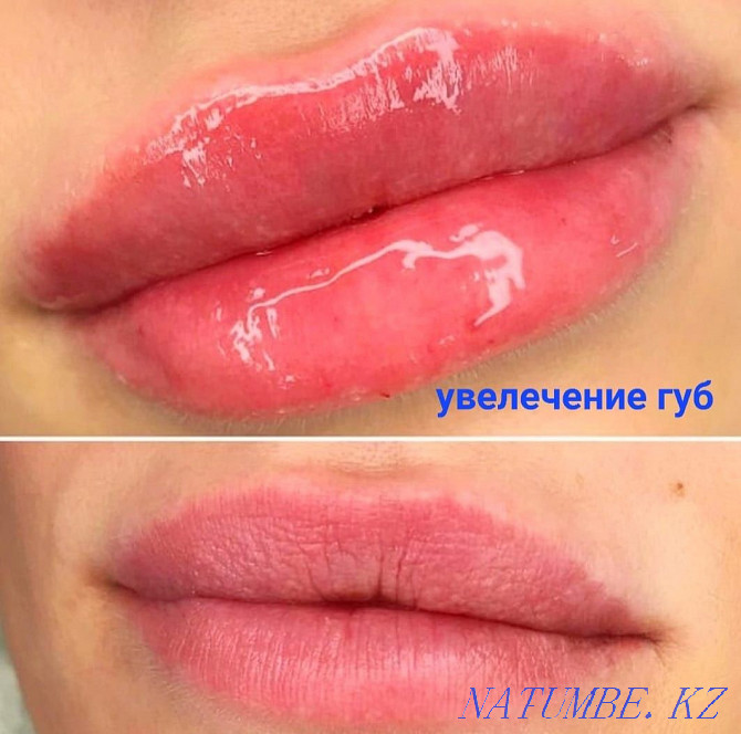 Looking for models for lip augmentation and Botox! Almaty - photo 2