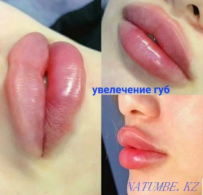 Looking for models for lip augmentation and Botox! Almaty - photo 3