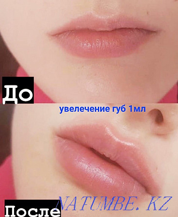 Looking for models for lip augmentation and Botox! Almaty - photo 4