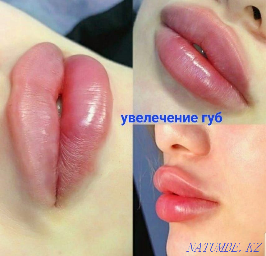 Ищу моделей на увеличение губ и ботокс! Алматы - изображение 3