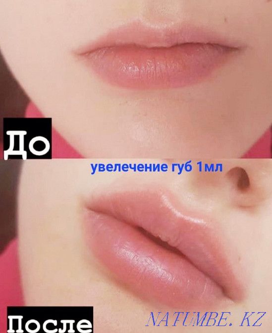 Ищу моделей на увеличение губ и ботокс! Алматы - изображение 4