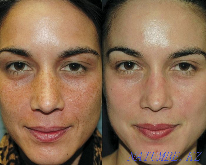 chemical peeling + phototherapy as a gift Qaskeleng - photo 7