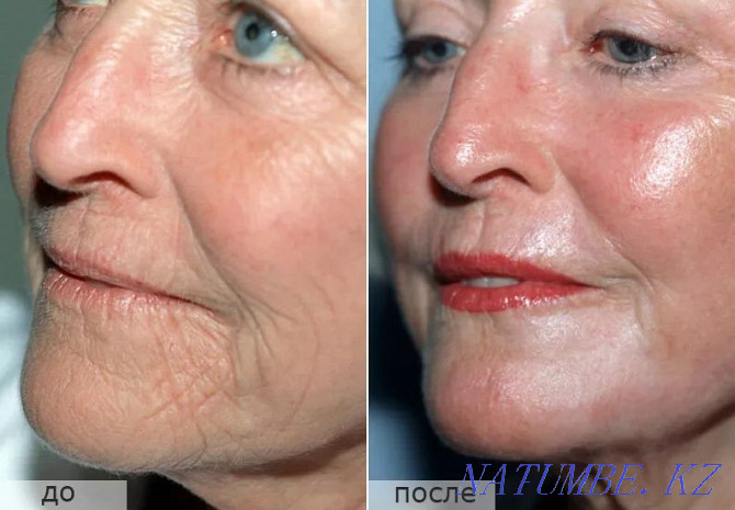 chemical peeling + phototherapy as a gift Qaskeleng - photo 4