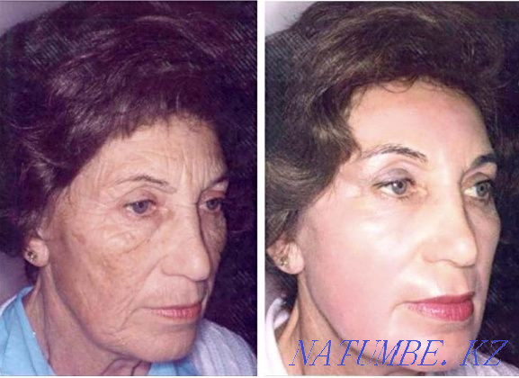 chemical peeling + phototherapy as a gift Qaskeleng - photo 2