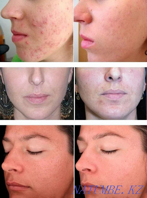 химический пилинг + светолечение в подарок по акции Каскелен - изображение 5