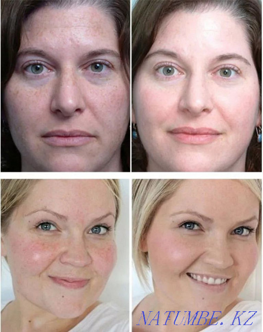 химический пилинг + светолечение в подарок по акции Каскелен - изображение 3