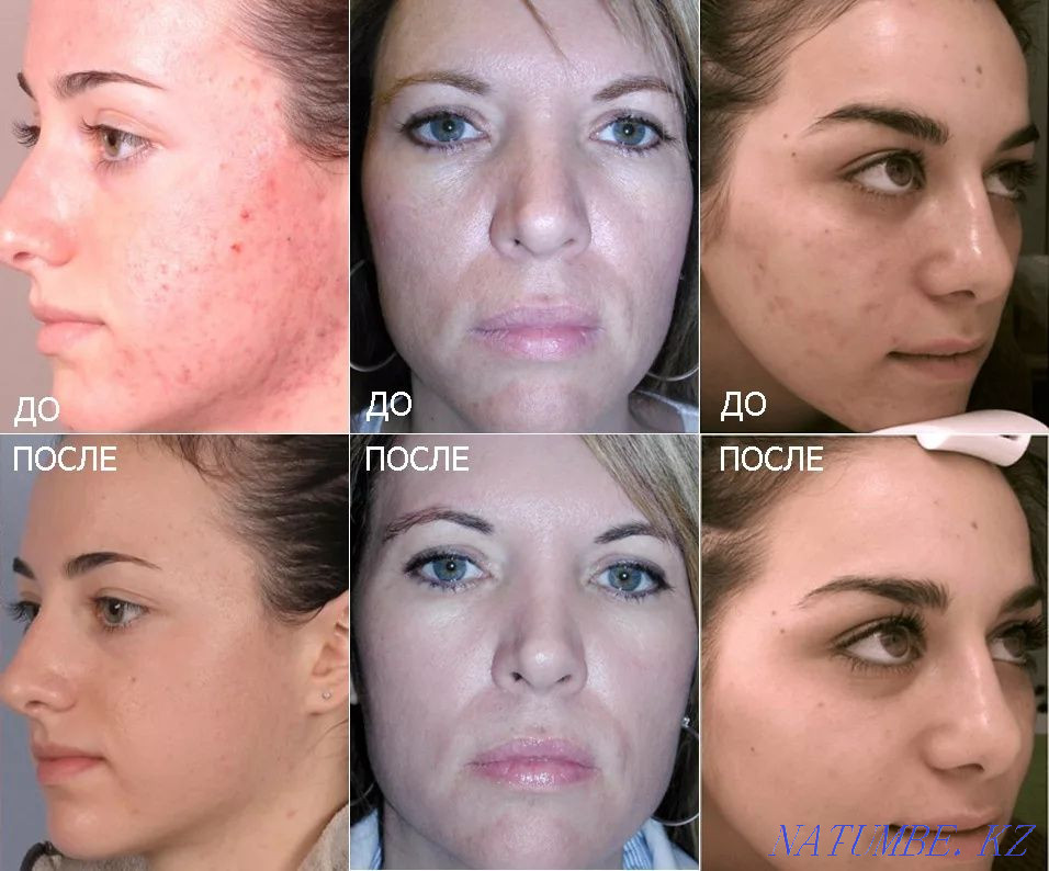 химический пилинг + светолечение в подарок по акции Каскелен - изображение 6