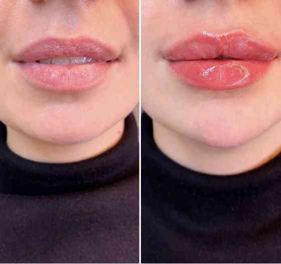 Косметолог, чистка лица, Увеличение губы, Ультразвуковая чистка лица Almaty
