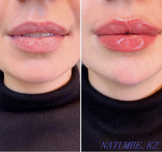 Cosmetologist, facial cleansing, Lip augmentation, Ultrasonic facial cleansing Almaty - photo 3