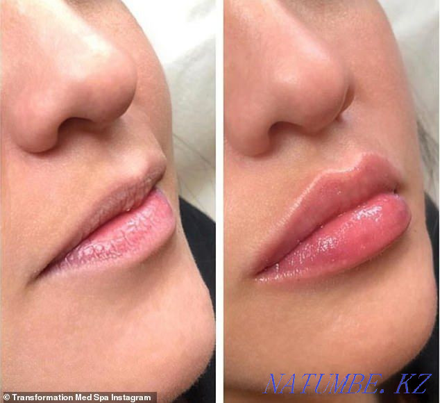 Cosmetologist, facial cleansing, Lip augmentation, Ultrasonic facial cleansing Almaty - photo 2