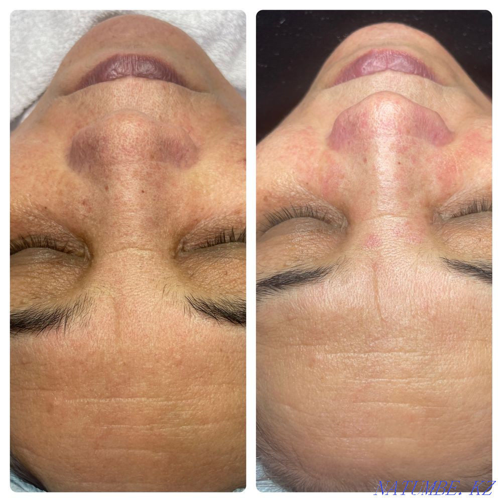 Косметолог - бет тазалау  Атырау - изображение 4