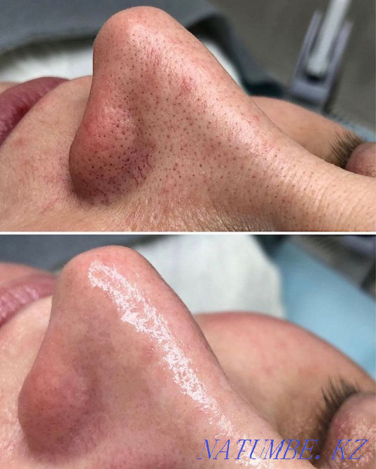 Косметолог - бет тазалау  Атырау - изображение 5