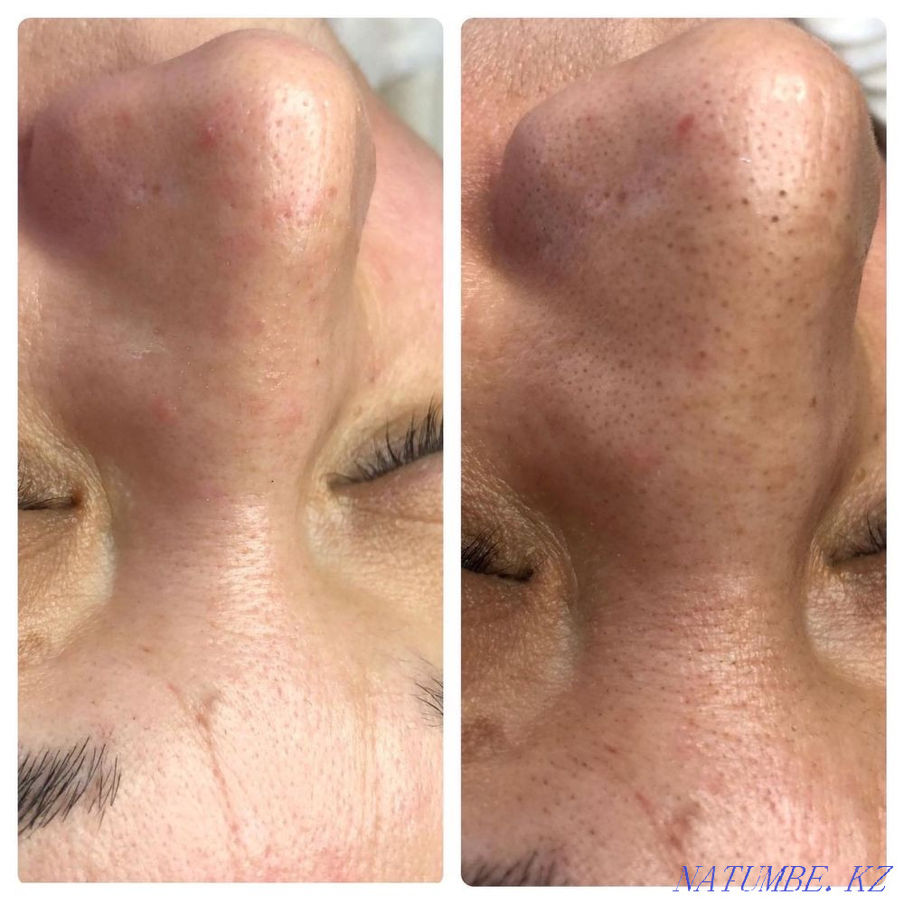 Косметолог - бет тазалау  Атырау - изображение 2