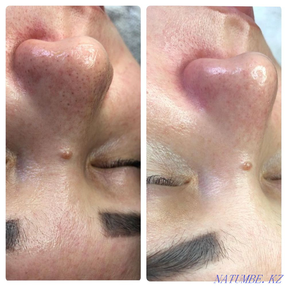 Косметолог - бет тазалау  Атырау - изображение 3