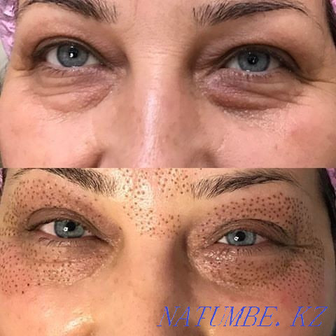 Non-surgical blepharoplasty, microneedling rejuvenation Temirtau - photo 8