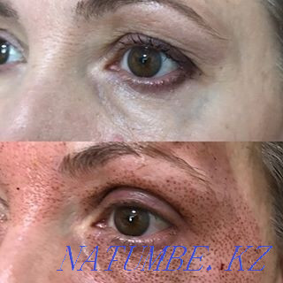 Безоперационная блефаропластика, микронидлинг омоложение Темиртау - изображение 6