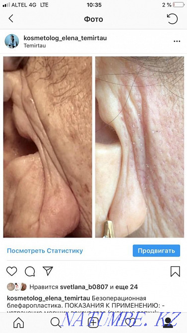 Безоперационная блефаропластика, микронидлинг омоложение Темиртау - изображение 2