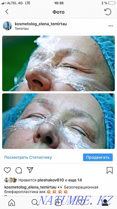 Безоперационная блефаропластика, микронидлинг омоложение Темиртау - изображение 1