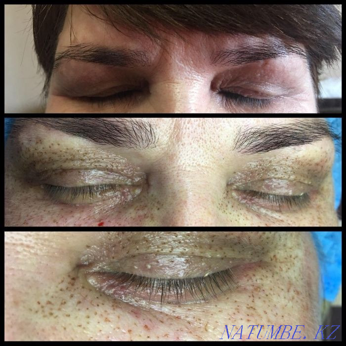 Безоперационная блефаропластика, микронидлинг омоложение Темиртау - изображение 7