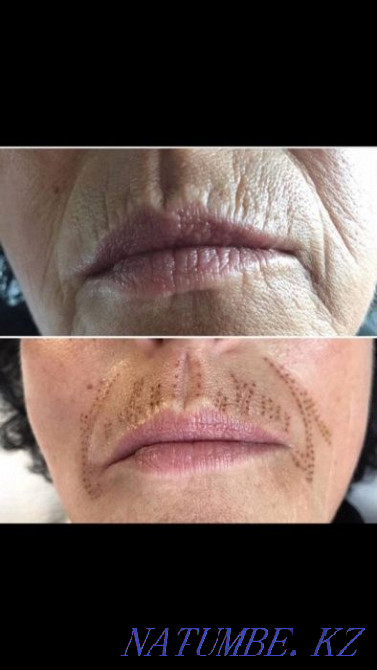 Безоперационная блефаропластика, микронидлинг омоложение Темиртау - изображение 4