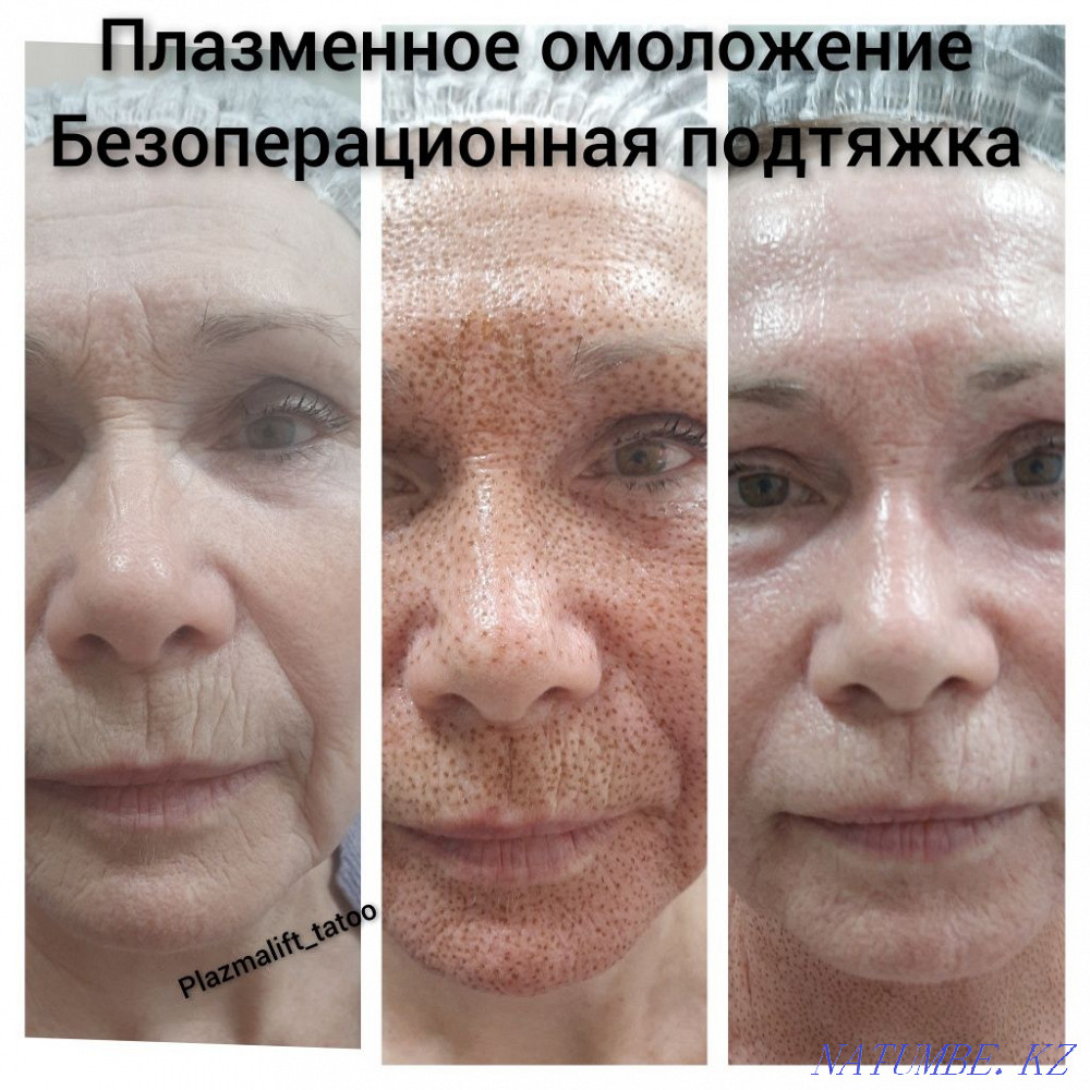 Омоложение. Красота. Алматы - изображение 7
