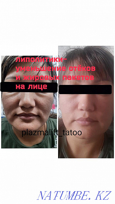 Омоложение. Красота. Алматы - изображение 6