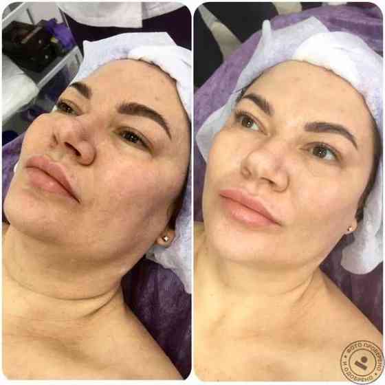 Чистка лица, Карбокситерапия Астана