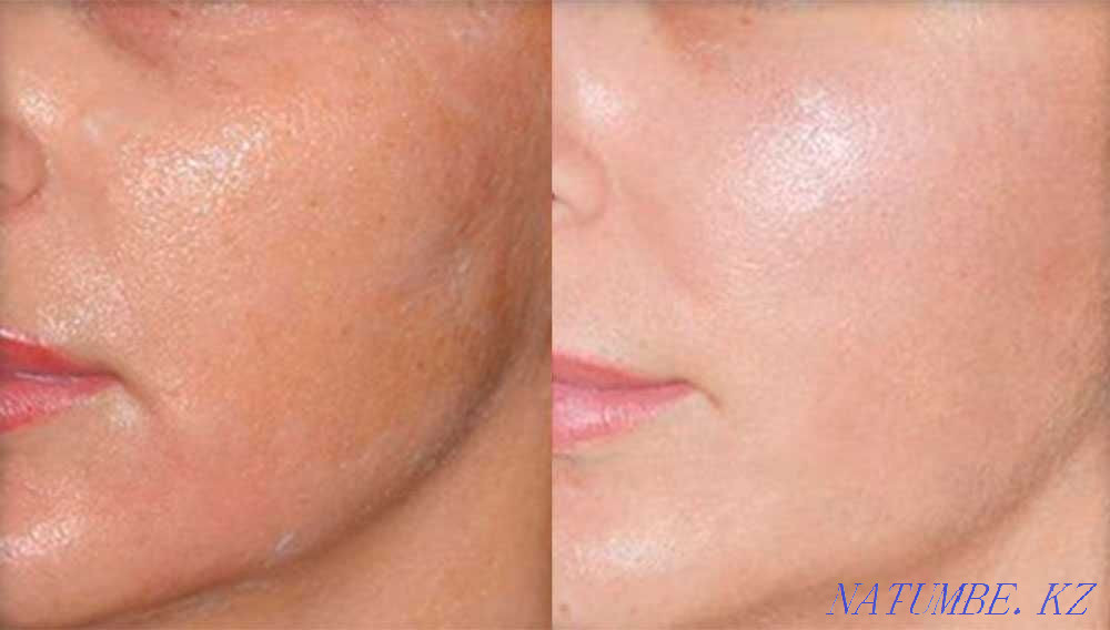 Чистка лица, Карбокситерапия Астана - изображение 2