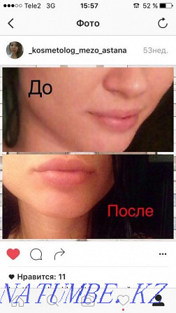 Promotion!!! Lip augmentation - from 26 thousand and above Astana - photo 5