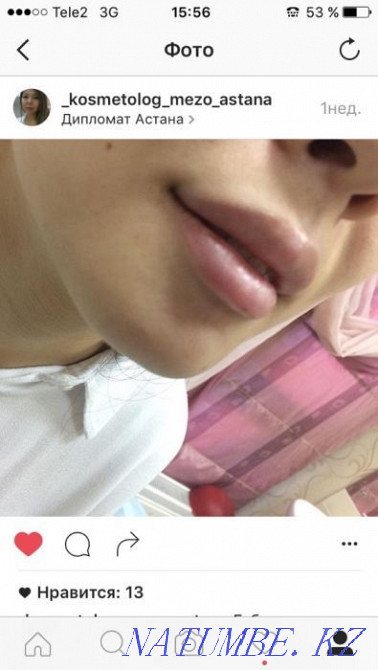 Акция!!!Увеличение губ -от26тыс и выше Астана - изображение 4