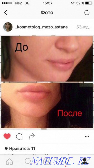 Акция!!!Увеличение губ -от26тыс и выше Астана - изображение 5