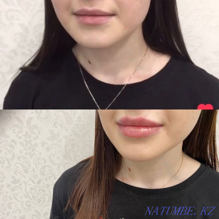 Акция!!!Увеличение губ -от26тыс и выше Астана - изображение 7