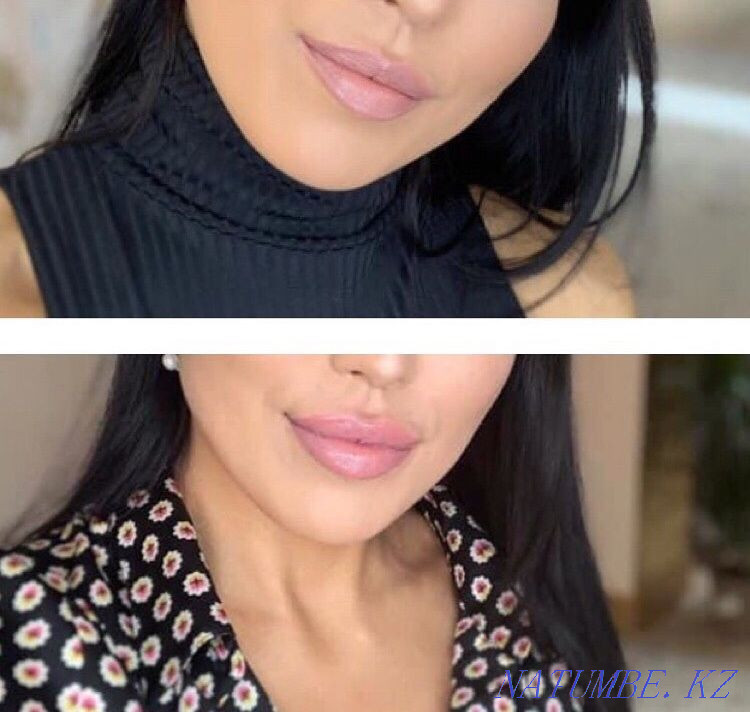 Акция!!!Увеличение губ -от26тыс и выше Астана - изображение 1