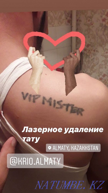Лазерное удаление татуировки, татуажа со скидкой Алматы - изображение 3
