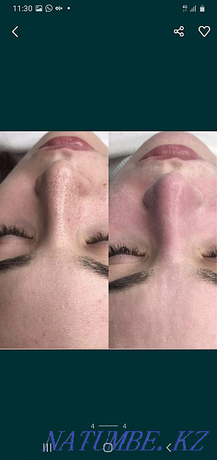 Комплексная чистка лица, массаж, калоген гель, маска Талгар - изображение 5