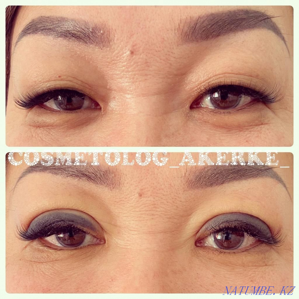 Lip Augmentation!Botox!Blefraplasty!Dimples!Meso!Beebiglow Kyzylorda - photo 3