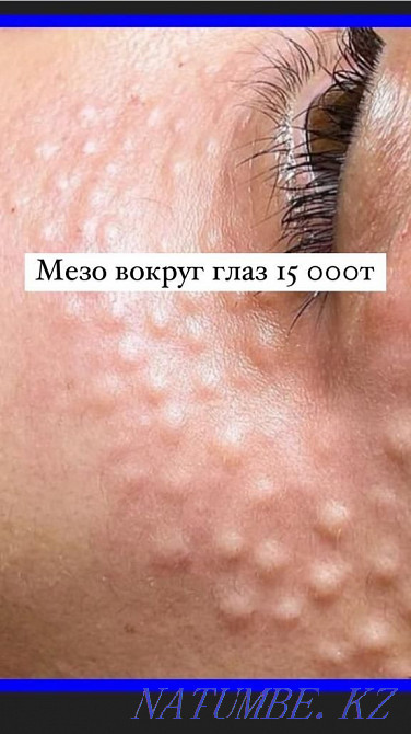 Lip Augmentation!Botox!Blefraplasty!Dimples!Meso!Beebiglow Kyzylorda - photo 7