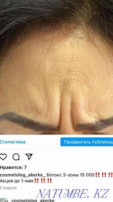 Lip Augmentation!Botox!Blefraplasty!Dimples!Meso!Beebiglow Kyzylorda - photo 5