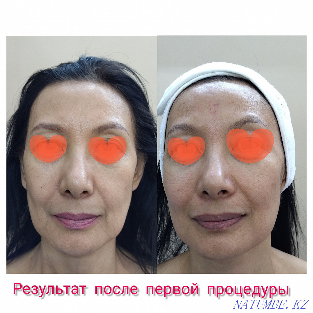 Акция!!!Бетке мүсіндік массаж + бет фитнес  Астана - изображение 1