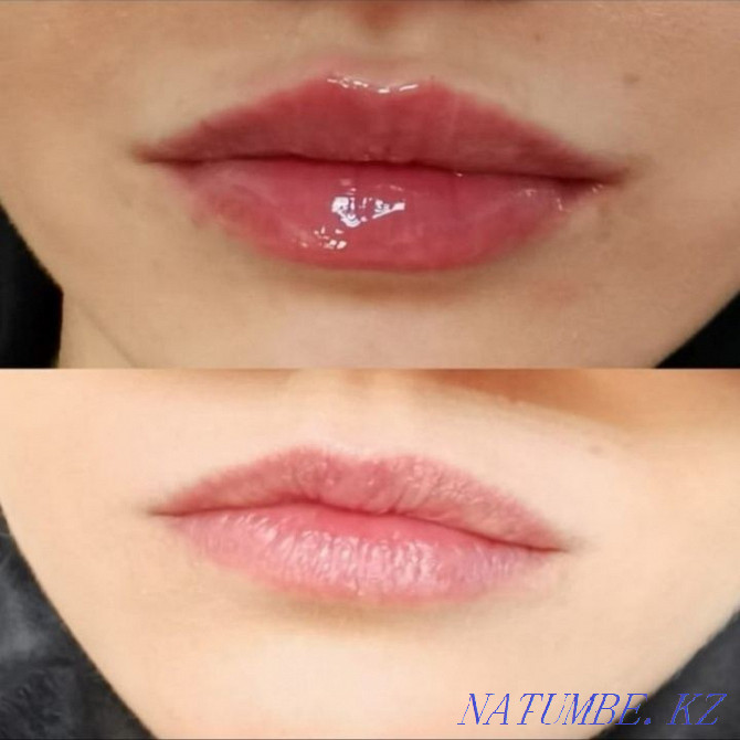 Lip augmentation 28.000 Almaty - photo 1