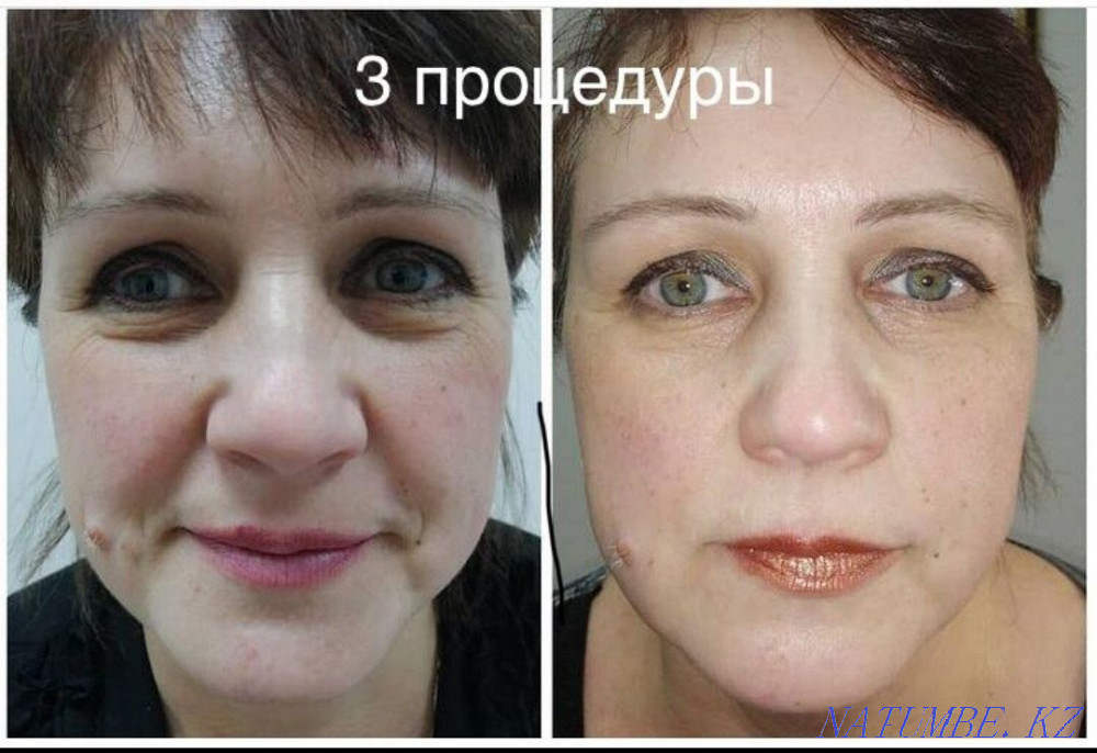 Омоложение и лечение! Холодная плазма!!! Блефаропластика! Астана - изображение 6