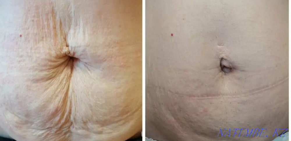 Омоложение и лечение! Холодная плазма!!! Блефаропластика! Астана - изображение 5