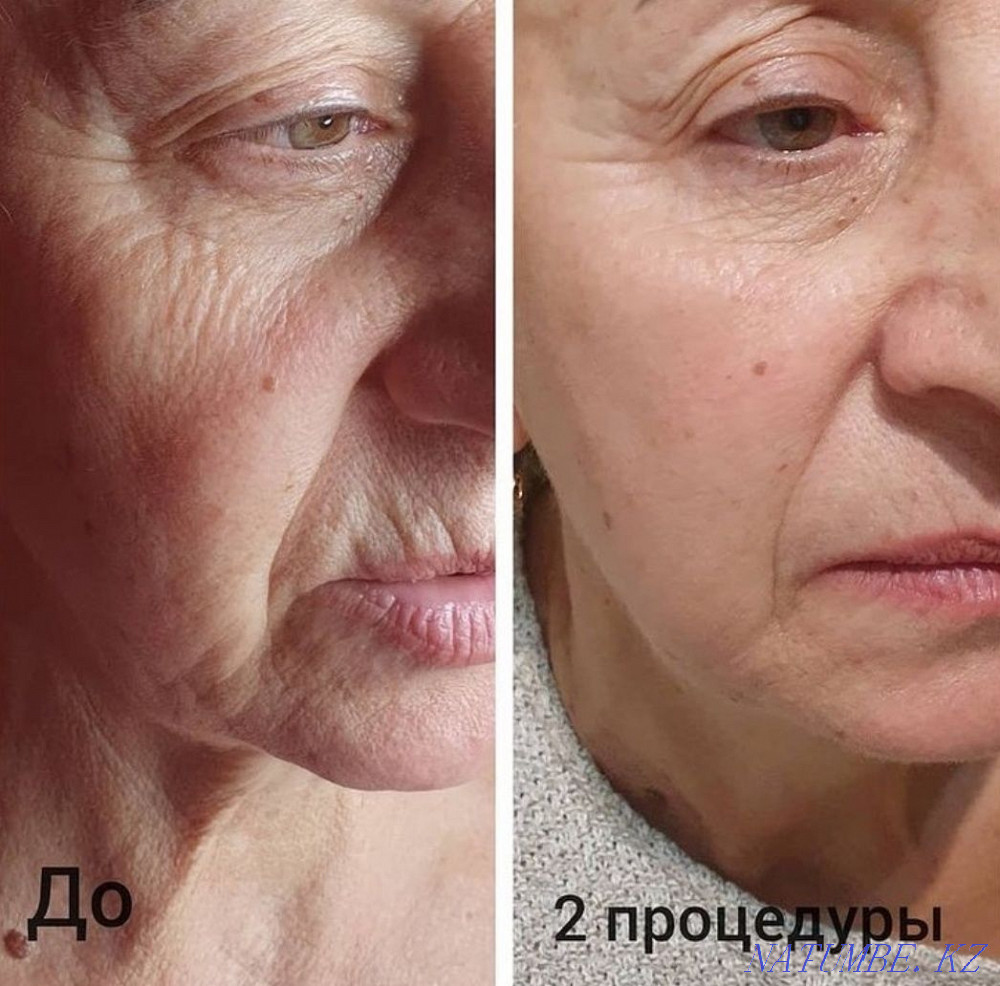 Омоложение и лечение! Холодная плазма!!! Блефаропластика! Астана - изображение 4