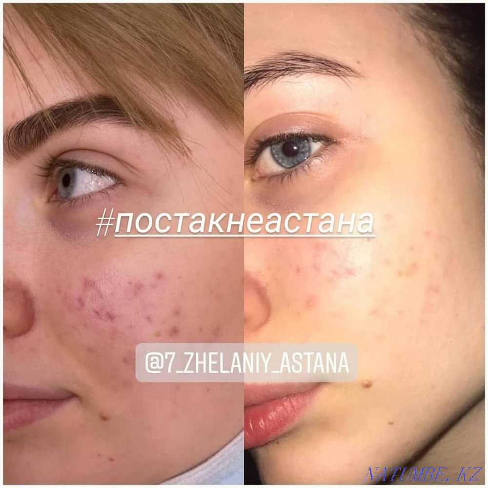 Омоложение и лечение! Холодная плазма!!! Блефаропластика! Астана - изображение 2